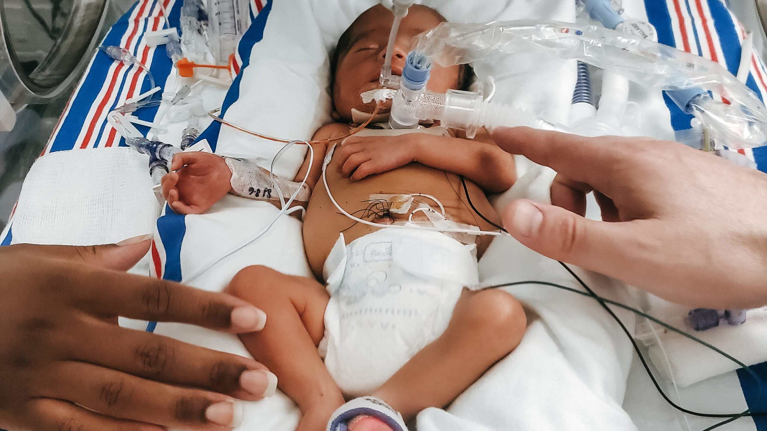 Baby Cassian was diagnosed during pregnancy with a dangerous condition that threatened his ability to breathe after birth.