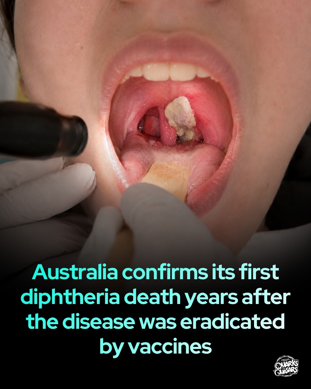 Man dies from Diphtheria in Darwin, Australia on May 26, 2026!